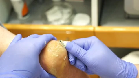 Podologic pedicure Stock Footage 178443099