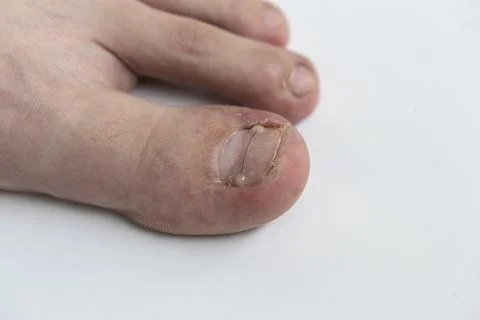 Podological brace from titanium thread on toe nail with onychocryptosis or Foto stock