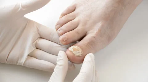 Podologist checking the left foot toe nail suffering from fungus infection Vidéo 67977931