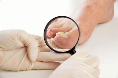 Podologist checking the patient foot 库存照片
