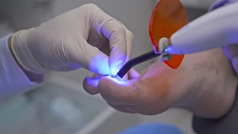 Podologist heats the guide bracket with the device on the patient diseased nail Stock Footage 169796329