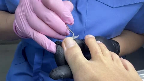 Podologist puts a tomponade under the nail. Podological pedicure. Stock Footage 330229944