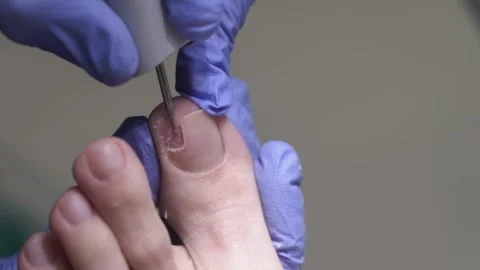 The podologist scrapes the nail with a buffing attachment Stock Footage 268119706