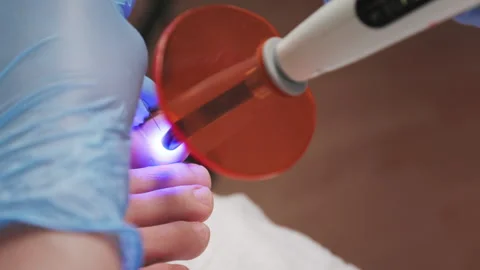 Podologist treatment a titanium thread on the big toe and using UV gadget Stock Footage 200813065