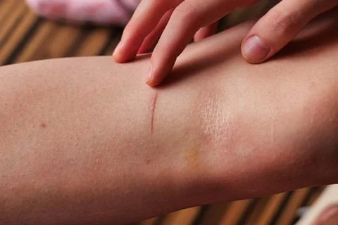 Pointing to Thin White Linear Scar on Human Arm Skin Stock Photos