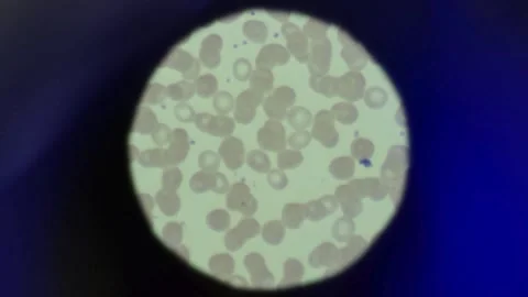 Poliovirus under the microscope, in an eradication study. in the laboratory Stock Footage 336583787