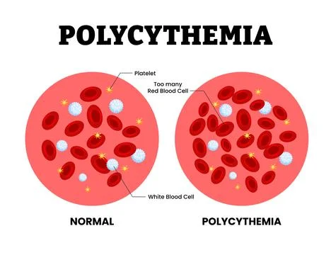 Polycythemia vs normal blood specimen blood composition comparison. Human b.. Stock Illustration