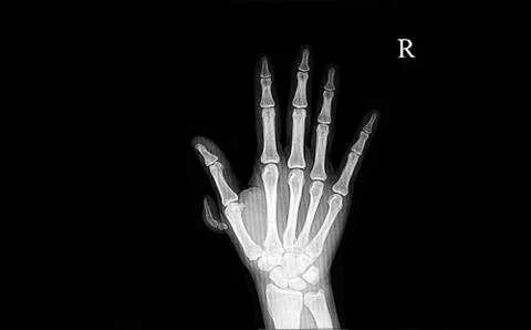 Polydactyly Stock Photos