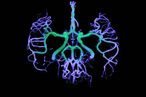 Polygon of willis The circle of Willis is an arterial circle located at th... Stock Photos