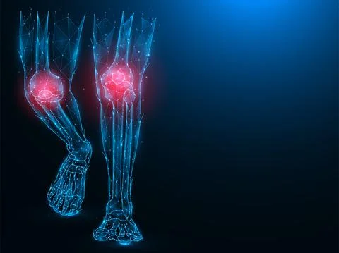 Polygonal vector illustration of human legs, painful and inflamed knees. Sick Stock Illustration