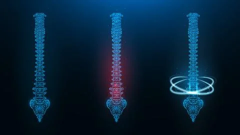 Polygonal vector illustration of a human spine. Image of a healthy, sick and  Stock Illustration