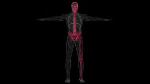 Polyostotic Paget's disease of bone is a chronic skeletal disorder affecting 動画素材 345125644