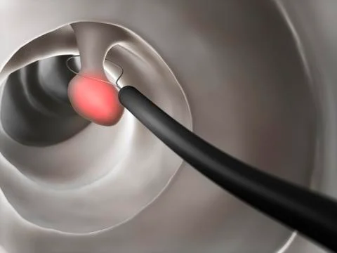 Polyp removal, artwork Stock Illustration