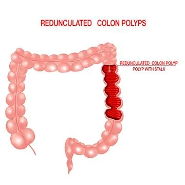 Polyp with stalk. Redunculated. Concept.Vector realistic illustration. Stock Illustration