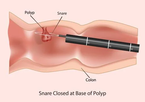Polypectomy using colonoscopy Stock Illustration