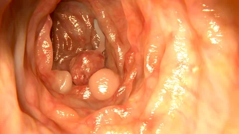 Polyps in a human intestine Stock Footage 140812528