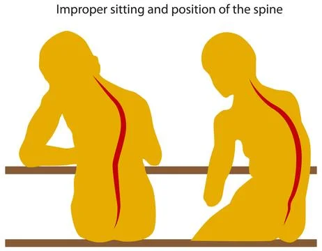Poor Posture Diagram Illustrazione stock