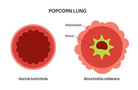 Popcorn lung disease Stock Illustration