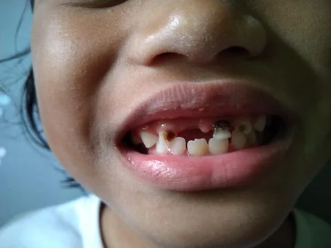 Porous Teeth Foto stock