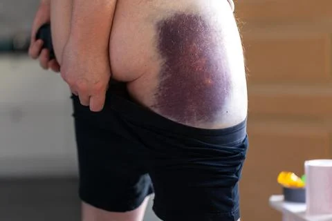 A  portrait of a big black and blue bruise due to a fall on the right hip a.. Stock Photos