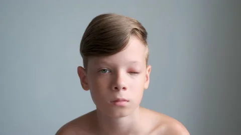 Portrait of boy with a swollen eye from an insect bite. Allergy to insect bites. Video stock 158199551