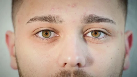 Portrait close up of man's face with acne skin condition opening hazel eyes. Stock Footage 167525003