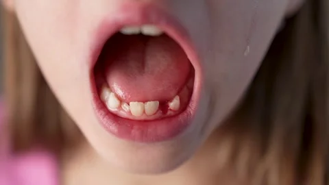 Portrait of a girl crying after pulling out her baby teeth, close-up. Stock Footage 274478033