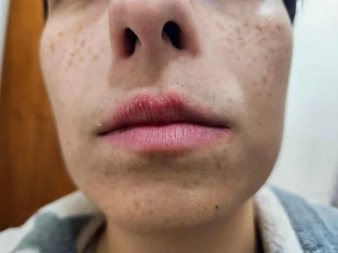 Portrait of lips chapped by the cold Stock Photos
