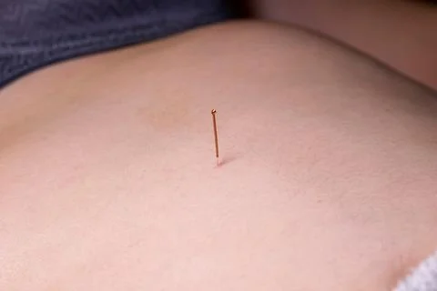 A portrait of a thin acupuncture needle between navel and sternum, put in pla Stock Photos