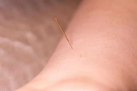 A portrait of a thin acupuncture needle a bit above the ankle, put in place b Stock Photos