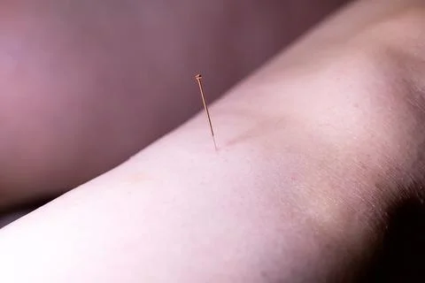 A portrait of a thin acupuncture needle in the side of a leg, put in place by Stock Photos