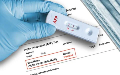 Positive AFP test result by using rapid self testing cassette for Alpha Fetop Stock Photos