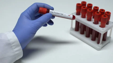 Positive Liver function test, doctor showing blood sample in tube, lab research Stock Footage 105203280