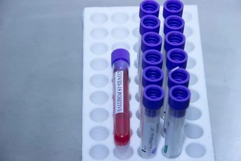 Positive test for Coronavirus Stock Photos
