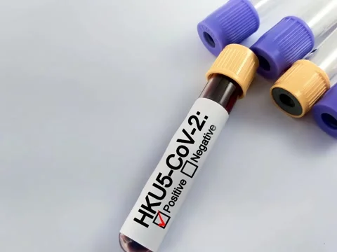 Positive test result for HKU5-CoV-2, coronavirus causing COVID-19 disease. Stock Footage 302819329