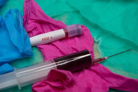 Positive testing at HIV Foto stock