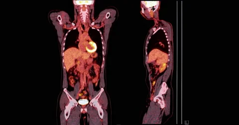 Positron emission tomography (PET) CT sc... | Stock Video | Pond5