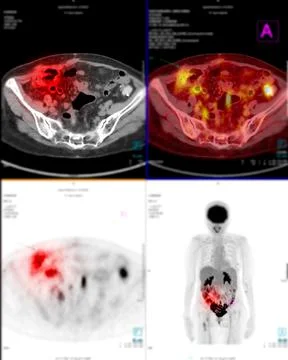 Positron emission tomography (PET) CT scan of Whole  human body. Stock Illustration