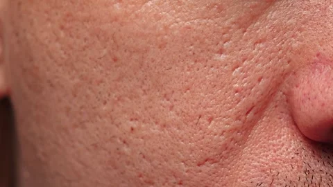 Post-acne man with scars on face texture close up Stock Footage 340030525