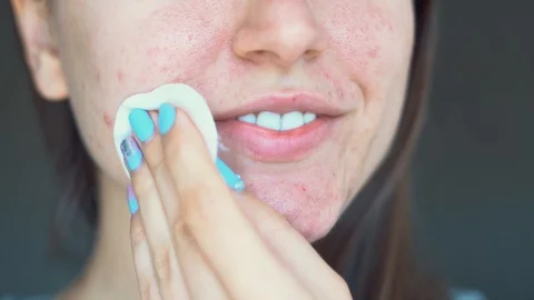 Post-acne, scars and red festering pimples on the face of a young woman. Video stock 105563221