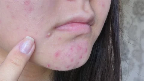 Post acne, scars and red festering pimples on the face Video stock 313353446