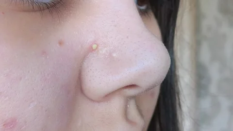 Post acne, scars and red festering pimples on the face Stock Footage 313353504