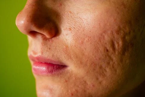 Post-acne, scars and red festering pimples on the face of a young woman. concept Stock Photos