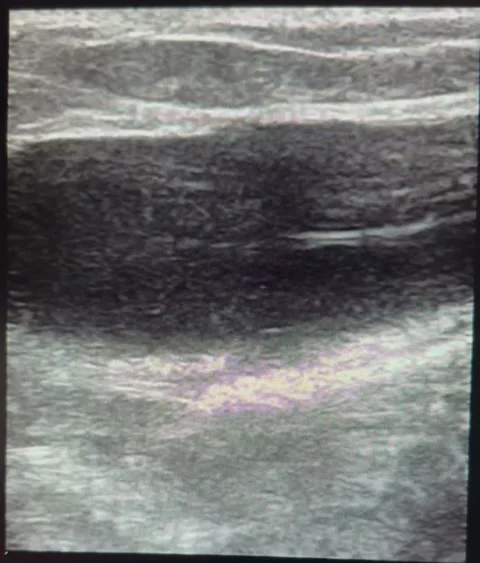 Post inguinal hernia surgery seroma formation on ultrasound, macro shot Stock Footage 291250804