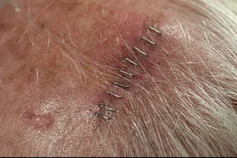 Post-surgery View of Mohs Procedure Site Stock Photos