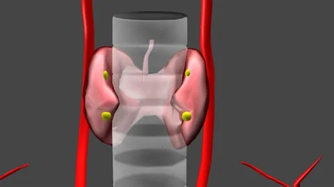 Post Thyroid Surgery Hematoma Video stock 50117099