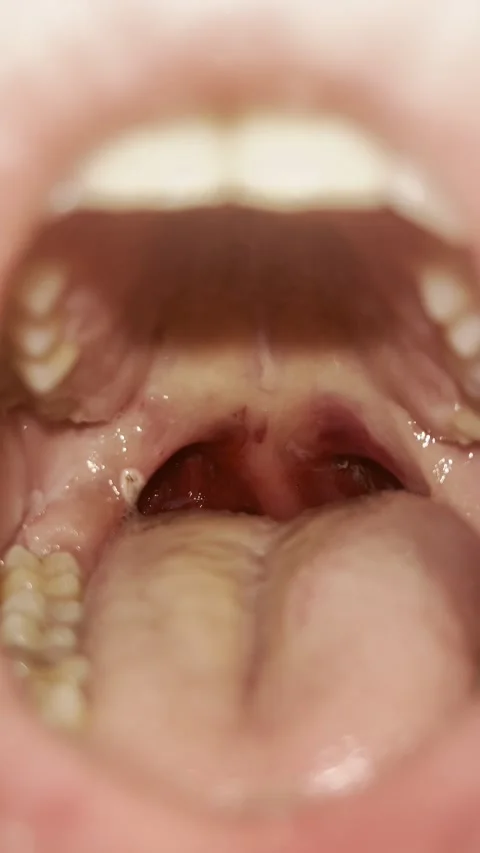 Post-Tonsillectomy Day 0 — Immediate Post-Surgical Intraoral Assessment Stock Footage 336393622