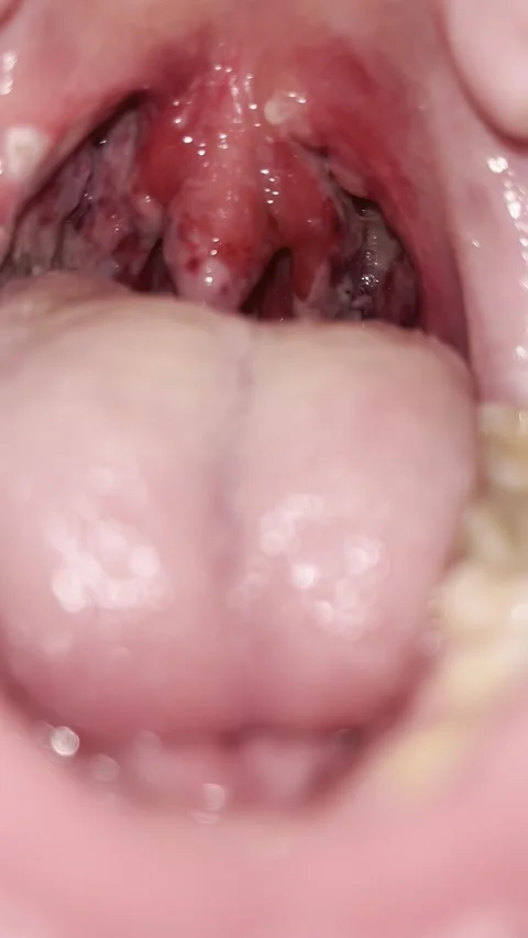 Post-Tonsillectomy Day 1 — Early Fibrin Formation Stock Footage 336393700