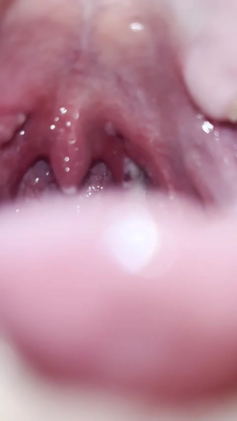 Post-Tonsillectomy Day 10 — Second Clinical Follow-Up Stock Footage 336393718