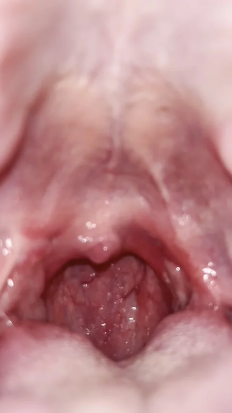 Post-Tonsillectomy Day 19 — Late Stage Healing, Mucosal Surface Assessment Stock Footage 336393654
